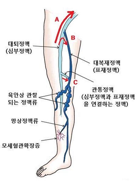 하지정맥류 혈관이 울퉁불퉁할 때만 수술 필요할까