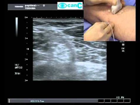 Popliteal Nerve Block Ultrasound