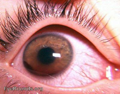 Blood In The Eye Managing Hyphema Eyedolatry