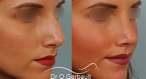 Rhinoplastie Primaire Par Le Dr Gerbault