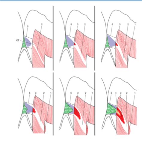 Histopathology of Caries Flashcards | Quizlet