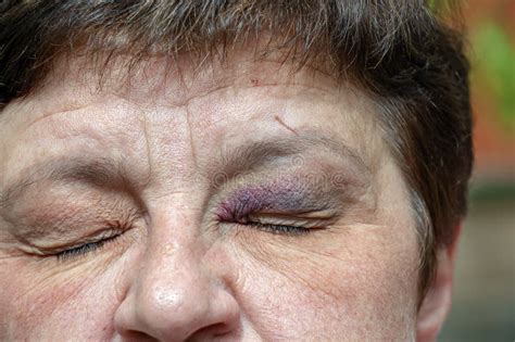 A Human Eye With A Large Black Violet Bruise Swelling Due To Bruise