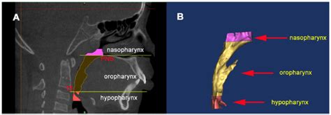 3d Model Of The Upper Airway Was Reconstructed A The Upper Airway