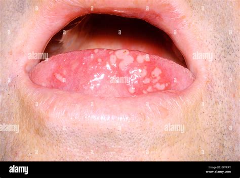 A Picture Of An Acute Vesicular Eruption On The Tongue Caused By Infection With Herpes Simplex