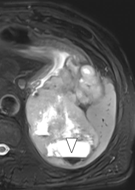 MRI Features Of Gastrointestinal Stromal Tumors AJR