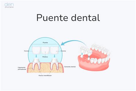 Qué es un puente dental y qué tipos hay