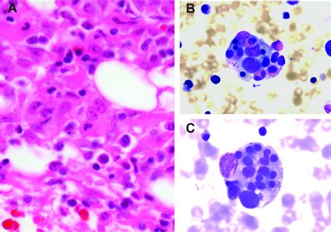 Histopathology Of Hlh A Histopathology Of A Bone Marrow Section In