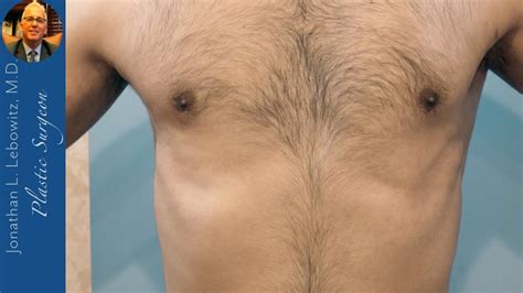 3 Months Post Op Vaserlipo Gynecomastia Surgery The Long Island Gynecomastia Center By Dr