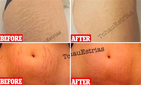 Tattoo Over Stretch Marks Skin Color Deceases Blogsphere Galleria Di