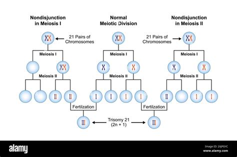 Trisomy 21 Syndrome Illustration Stock Photo Alamy