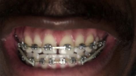 How To Close Gap In Teeth With Braces - How Long Do You Think It Will ...