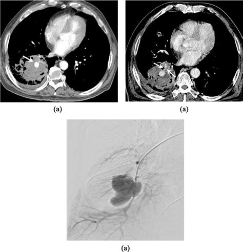 Figure 2 From Pulmonary Artery Pseudoaneurysm Showing Rapid Growth In A Patient With Lung Cancer