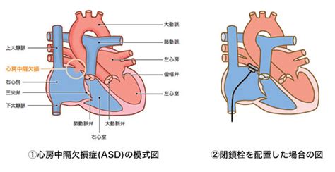 心房中隔欠損症卵円孔に対する経カテーテル閉鎖術｜東北大学大学院循環器内科学／東北大学病院循環器内科