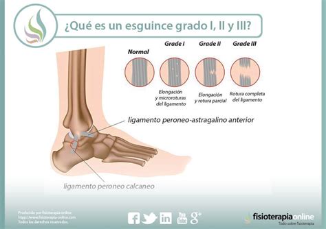 Todo lo que necesitas saber sobre el esguince de grado guía completa