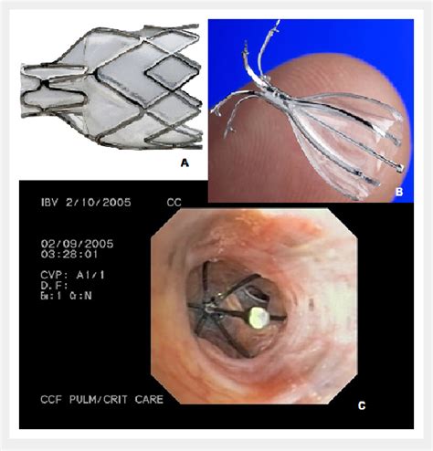 A Pulmonx Intrabronchial Valve B Spiration Valve Cbronchoscopic View