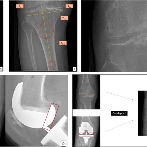 Radiographic Labeling And Calibration Of Preoperative And Postoperative