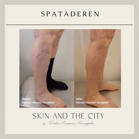 Spataderen Skin And The City