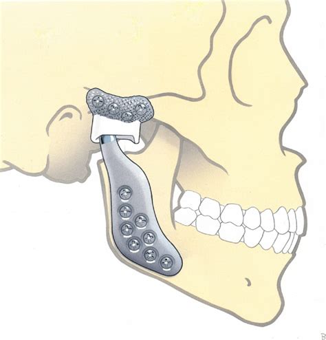 Biomaterials In Temporomandibular Joint Replacement Current Status And Future Perspectives—a