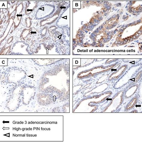 Prostate Adenocarcinoma Gleason Score 7 34 Original Download