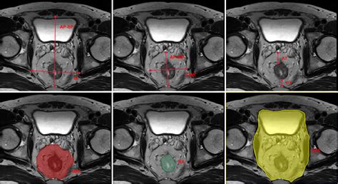 Frontiers Prognostic Value Of Mesorectal Package Area In Patients