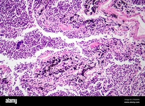 Photomicrograph Of Interstitial Pneumonia Showing Inflammation And