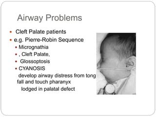 Cleft lip and palate ----- | PPT