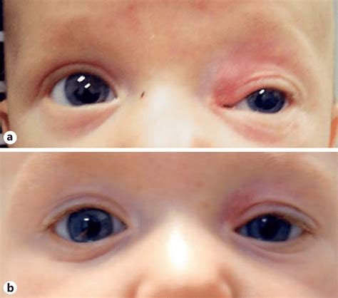 Eyelid Hemangioma