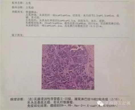 一分钟看懂乳腺癌病理报告单！ 知乎