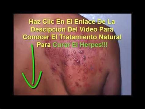 Como Curar El Herpes Facil Y De Manera Rapida Youtube