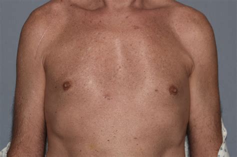 Male Pectoral Implants Front Before Dr Barry Eppley Indianapolis