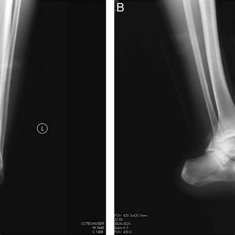 Anteroposterior A And Lateral B Radiographs Showing A Posteromedial Download Scientific