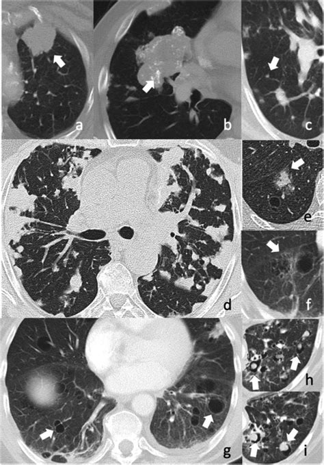 Ct Features In Amyloidosis Of The Respiratory System Comprehensive