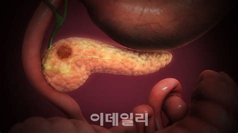 침묵의 ‘췌장암 조기 진단 키트 日서 등장jw중외 우리가 더 낫다