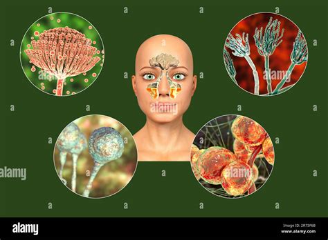 Fungi As A Cause Of Sinusitis Computer Illustration Showing