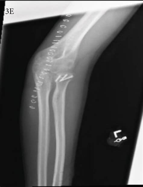 Radiographs At Final Follow Up Showing Healed Fractures Left Wrist Pa