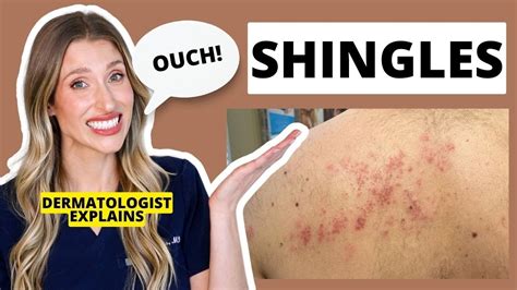 Dermatologist Explains Shingles Is It Contagious Shingles Treatments And Prevention Dr Sam