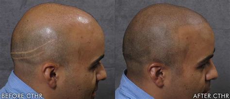 Hair Transplant Scar Removal