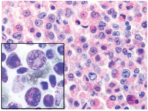 Leukemia, Eosinophilic, Acute; Eosinophilic Leukemia, Acute