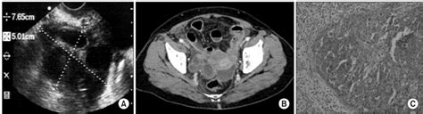 A Transvaginal Ultrasonography Showing A Multilocular Cyst With