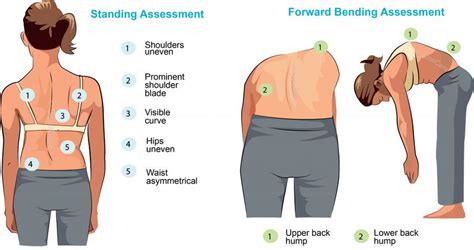 Scoliosis The Sideways Spinal Curve That Could Be Causing Your