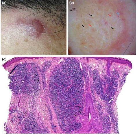 Primary Cutaneous Cd4 Small Medium Sized Pleomorphic T Cell