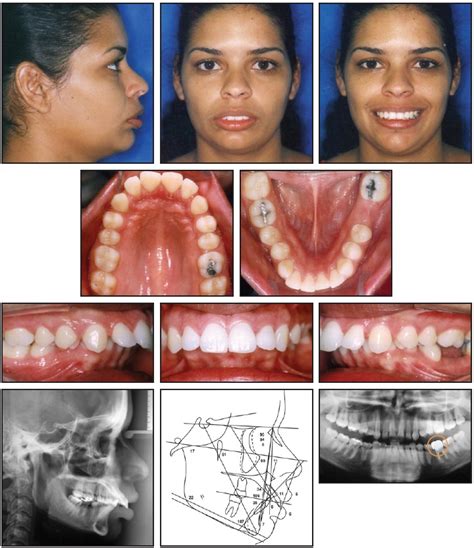 Case Report Jco Online Journal Of Clinical Orthodontics