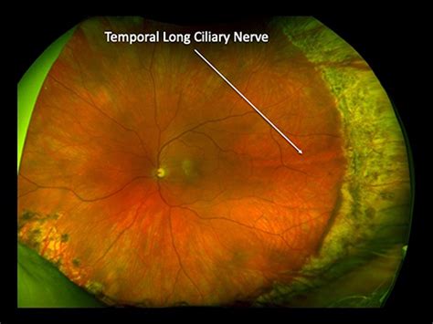 Preventing Retinal Detachment The Encircling Laser Retinopexy Techniq