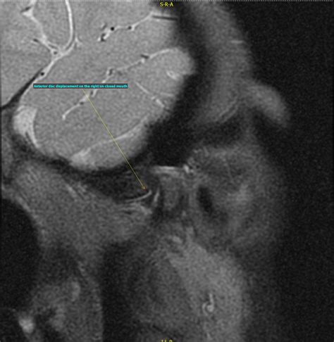 Temporomandibular Joint With Anterior Disc Dislocation And Recapture Image