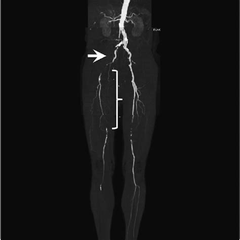 Preoperative Computed Tomography Angiography Cta Showing Total