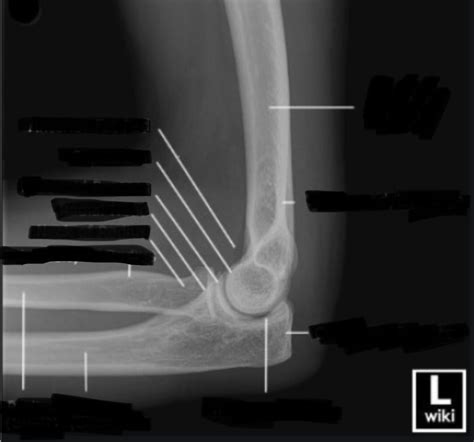 Lateral Elbow Labeling Diagram Quizlet