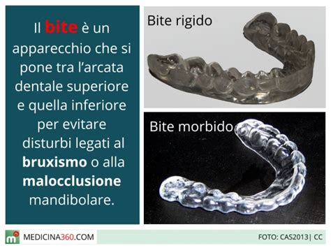 Bite per i denti: cos'è? A cosa serve? Tipi, benefici, costi e ...