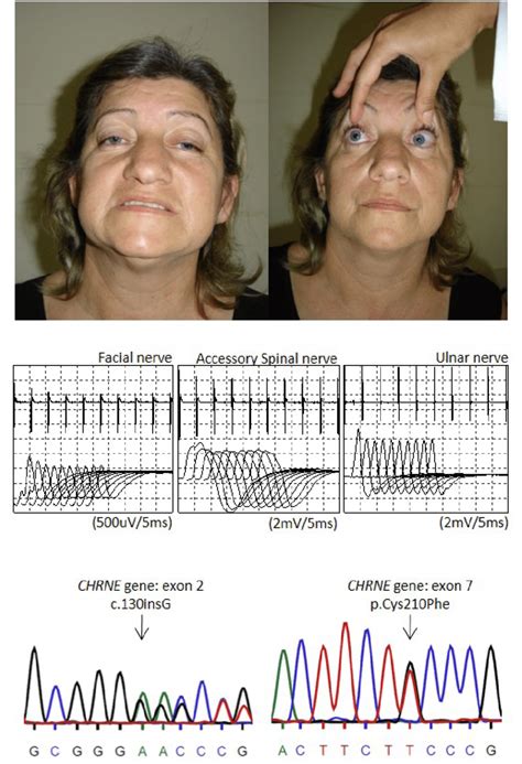 Patient With Chrne Congenital Myasthenic Syndrome Cms Showing Eyelid