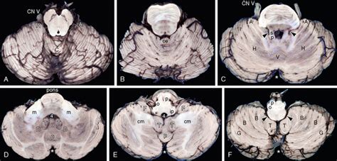 Cerebellum Anatomy Mri