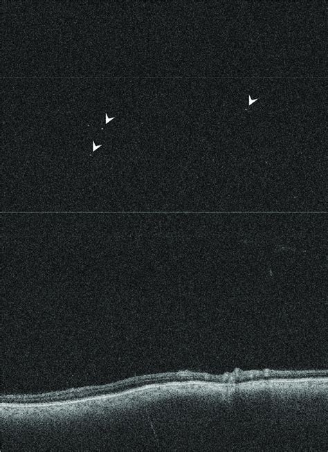 1 Patient With Panuveitis Oct Image Captured With The Binocular Oct